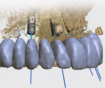 Planificación digital de implantes y restauraciones